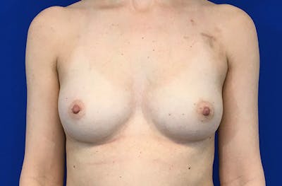Breast Implant Reconstruction Before & After Gallery - Patient 405257 - Image 1