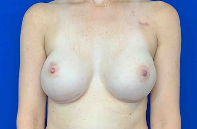 Breast Implant Reconstruction Before & After Gallery - Patient 405257 - Image 2