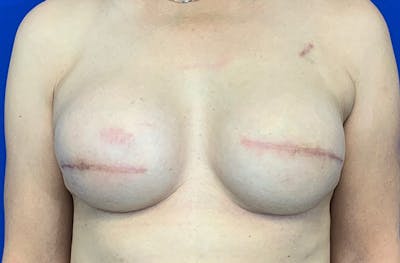 Breast Implant Reconstruction Before & After Gallery - Patient 393360 - Image 2