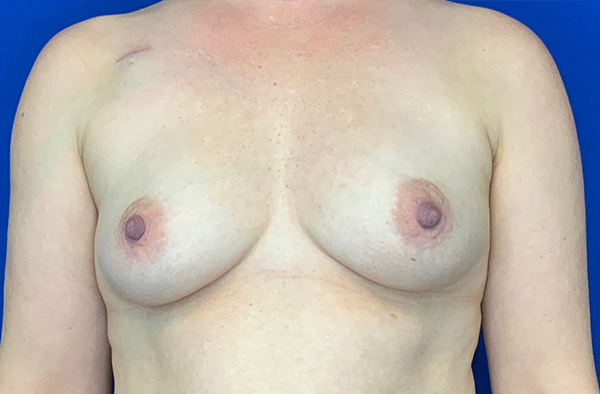 Breast Implant Revision