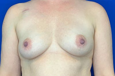 Breast Implant Reconstruction Before & After Gallery - Patient 263636 - Image 1