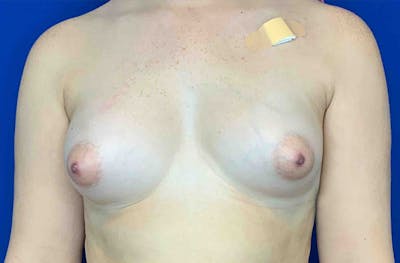 Breast Implant Reconstruction Before & After Gallery - Patient 234356 - Image 1