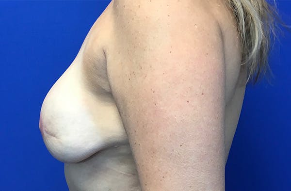 Breast Implant Reconstruction Before & After Gallery - Patient 267607 - Image 4