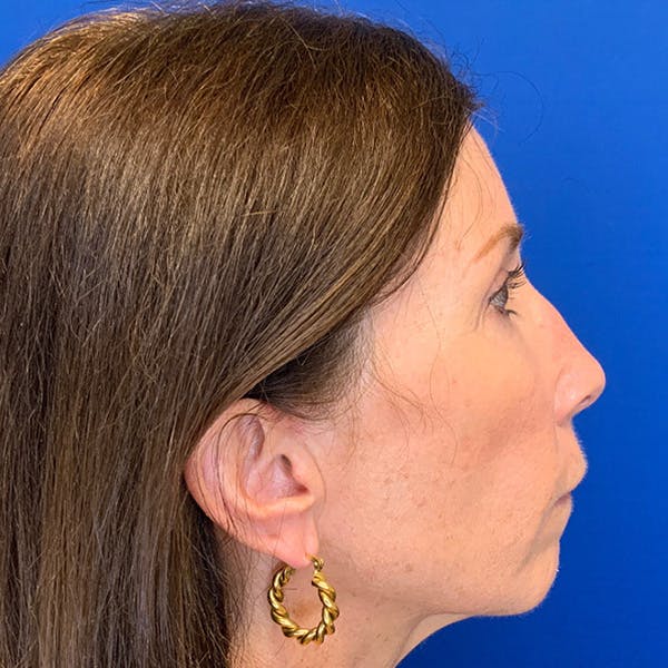 Rhinoplasty Before & After Gallery - Patient 270586 - Image 5