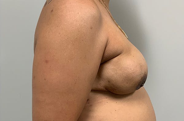 Breast DIEP Flap Reconstruction Before & After Gallery - Patient 199009 - Image 3