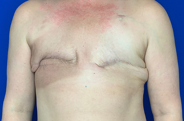 Breast Reconstruction