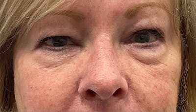 Blepharoplasty Before & After Gallery - Patient 379193 - Image 1