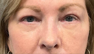 Blepharoplasty Before & After Gallery - Patient 379193 - Image 2