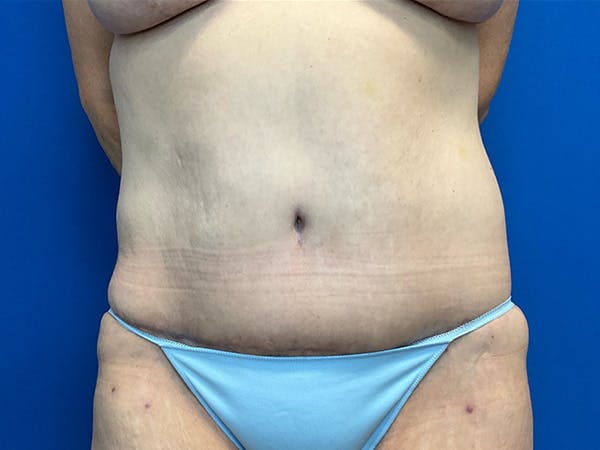Tummy Tuck (Abdominoplasty) Before & After Gallery - Patient 281185 - Image 2