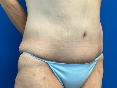 Tummy Tuck (Abdominoplasty) Before & After Gallery - Patient 281185 - Image 4