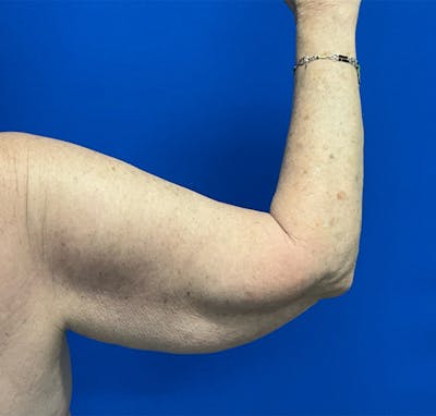 Arm Lift Before & After Gallery - Patient 877274 - Image 1