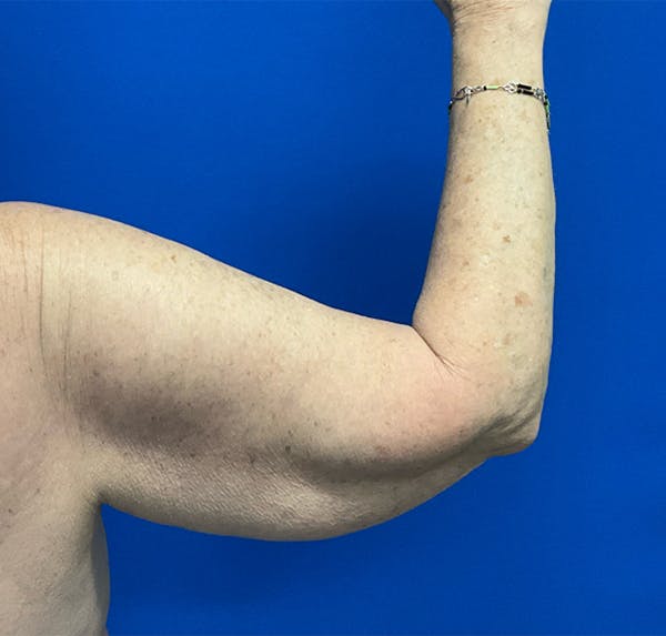 Brachioplasty
