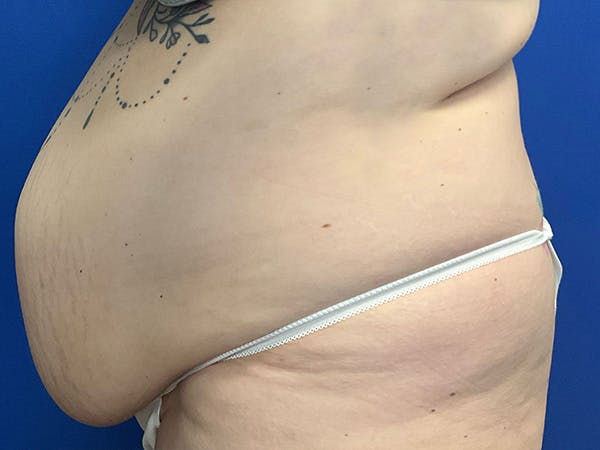 Tummy Tuck (Abdominoplasty) Before & After Gallery - Patient 330377 - Image 9