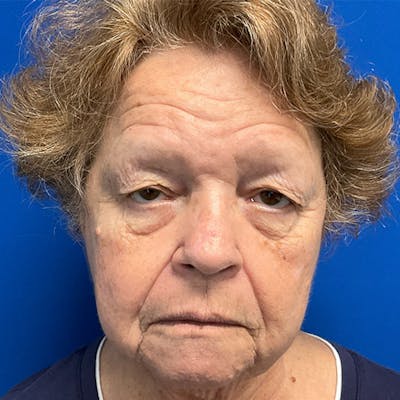 Blepharoplasty Before & After Gallery - Patient 192703 - Image 1