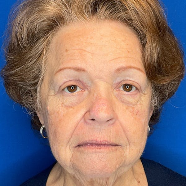 Eyelid Surgery