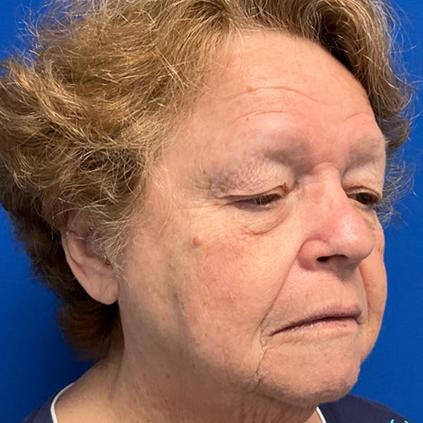 Blepharoplasty Before & After Gallery - Patient 192703 - Image 3