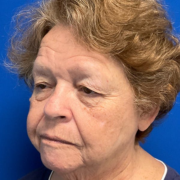 Blepharoplasty Before & After Gallery - Patient 192703 - Image 5