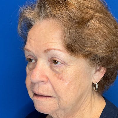 Blepharoplasty Before & After Gallery - Patient 192703 - Image 6