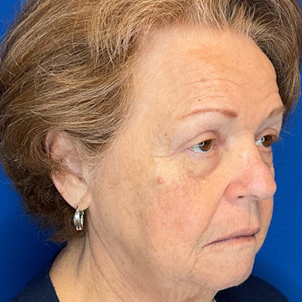 Blepharoplasty Before & After Gallery - Patient 192703 - Image 4