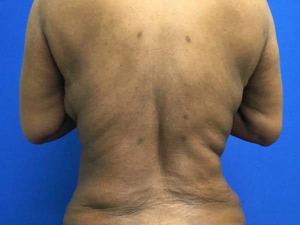 Liposuction Before & After Gallery - Patient 242598 - Image 2
