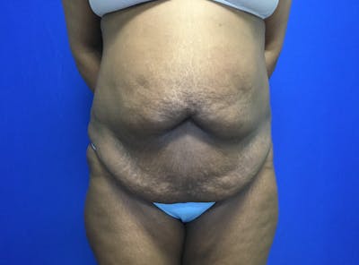 Tummy Tuck (Abdominoplasty) Before & After Gallery - Patient 119402 - Image 1