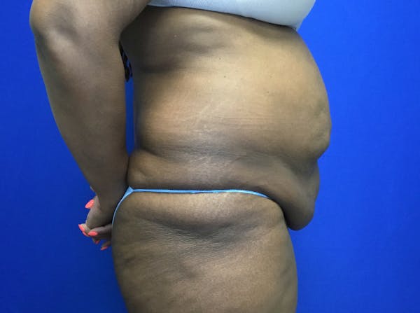 Tummy Tuck (Abdominoplasty) Before & After Gallery - Patient 119402 - Image 3
