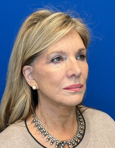 Face Lift Before & After Gallery - Patient 182345 - Image 4