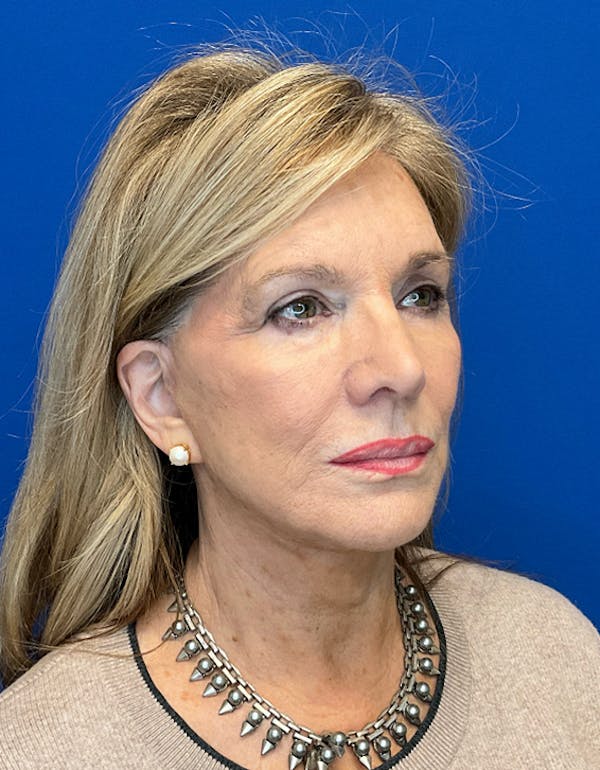 Face Lift Before & After Gallery - Patient 182345 - Image 4