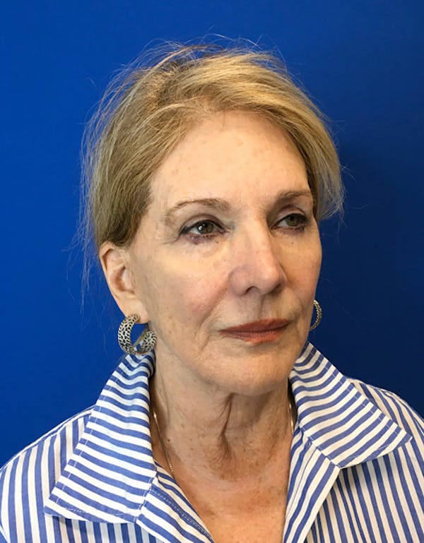 Face Lift Before & After Gallery - Patient 182345 - Image 3