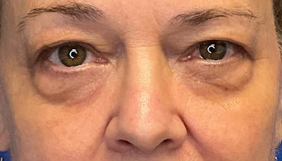 Blepharoplasty Before & After Gallery - Patient 421026 - Image 1