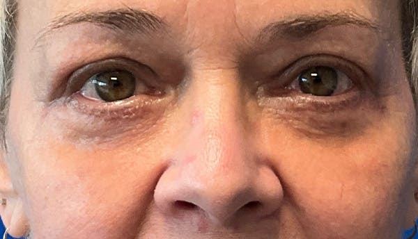 Blepharoplasty Before & After Gallery - Patient 421026 - Image 2