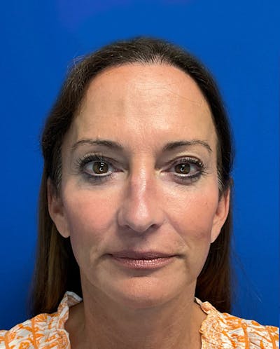 Hair Restoration Before & After Gallery - Patient 341765 - Image 2
