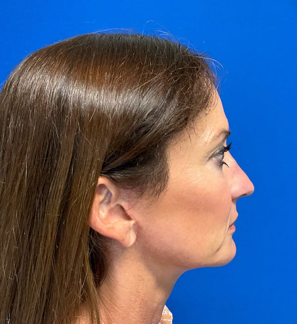 Hair Restoration Before & After Gallery - Patient 341765 - Image 4