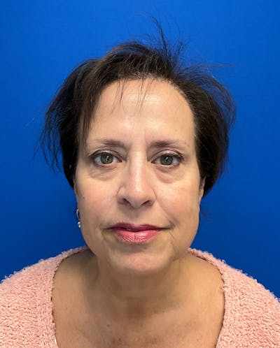 Hair Restoration Before & After Gallery - Patient 118861 - Image 4