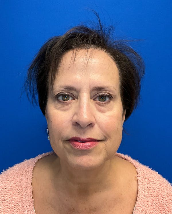 Hair Restoration Before & After Gallery - Patient 118861 - Image 4