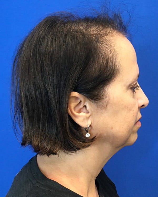 Hair Restoration Before & After Gallery - Patient 118861 - Image 7