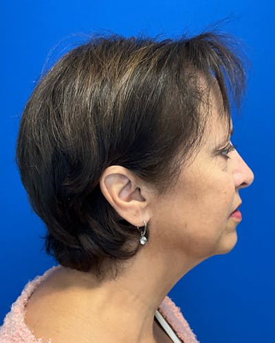 Hair Restoration Before & After Gallery - Patient 118861 - Image 8