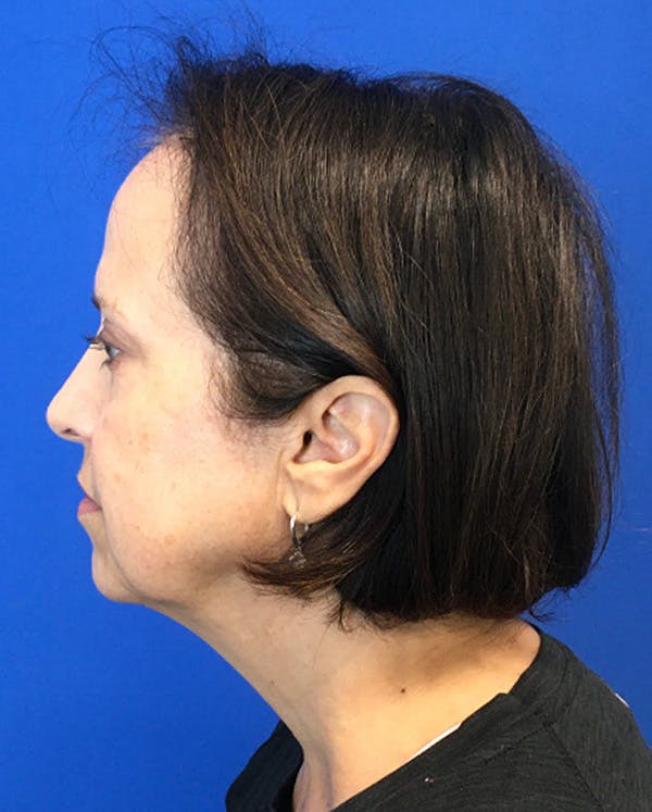 Hair Restoration Before & After Gallery - Patient 118861 - Image 9