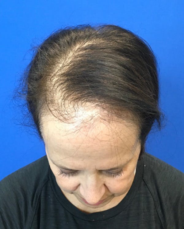 Hair Restoration Before & After Gallery - Patient 118861 - Image 5