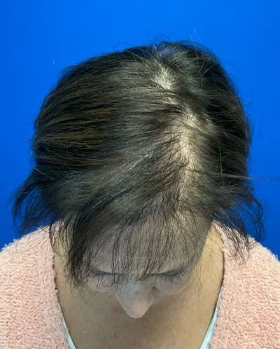 Hair Restoration Before & After Gallery - Patient 118861 - Image 6