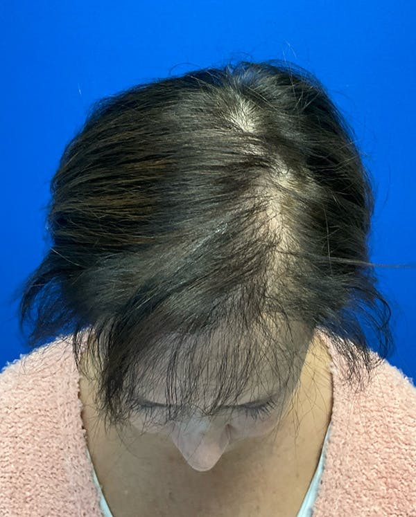 Hair Restoration Before & After Gallery - Patient 118861 - Image 6