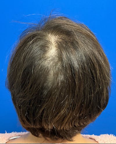Hair Restoration Before & After Gallery - Patient 118861 - Image 2
