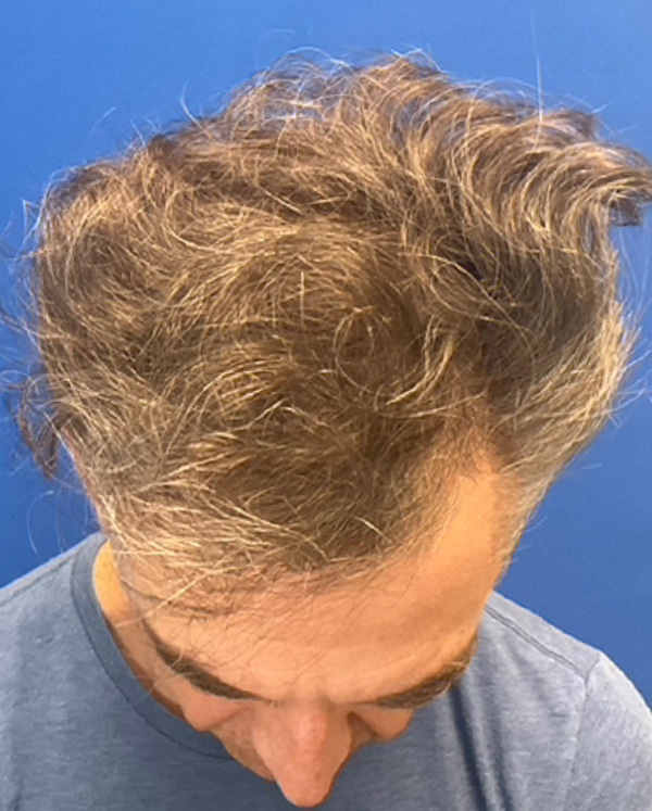 Hair Restoration