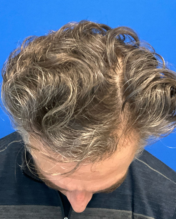 Hair Restoration