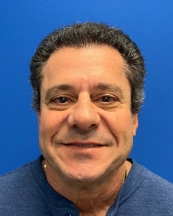 Hair Restoration