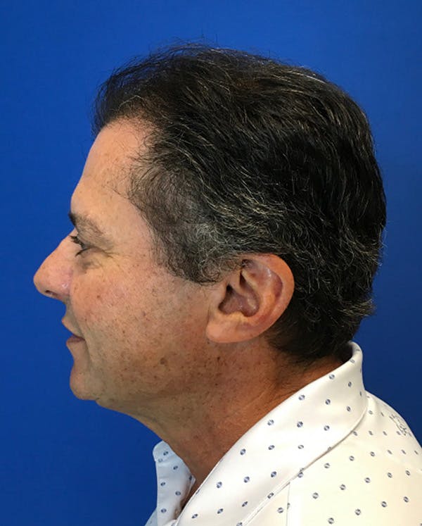 Hair Restoration Before & After Gallery - Patient 427264 - Image 5