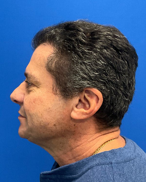 Hair Restoration Before & After Gallery - Patient 427264 - Image 6