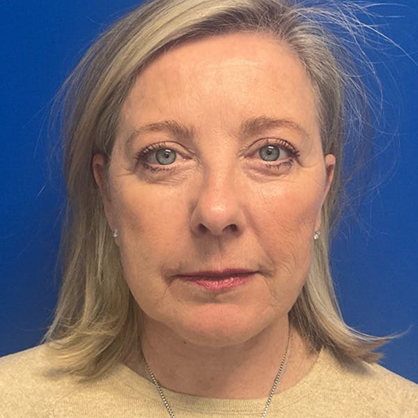 Face Lift Before & After Gallery - Patient 105189 - Image 2