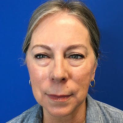 Blepharoplasty Before & After Gallery - Patient 179956 - Image 1