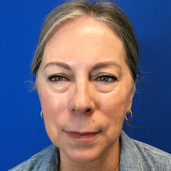 Blepharoplasty Before & After Gallery - Patient 179956 - Image 1